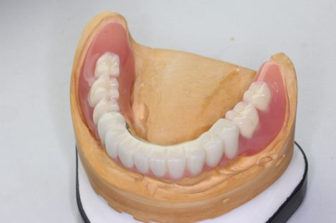 テレスコープ義歯というドイツで開発された入れ歯