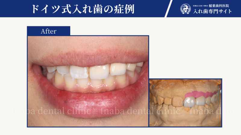 20代女性の奥歯3本の入れ歯治療〜素敵な笑顔を取り戻す方法〜