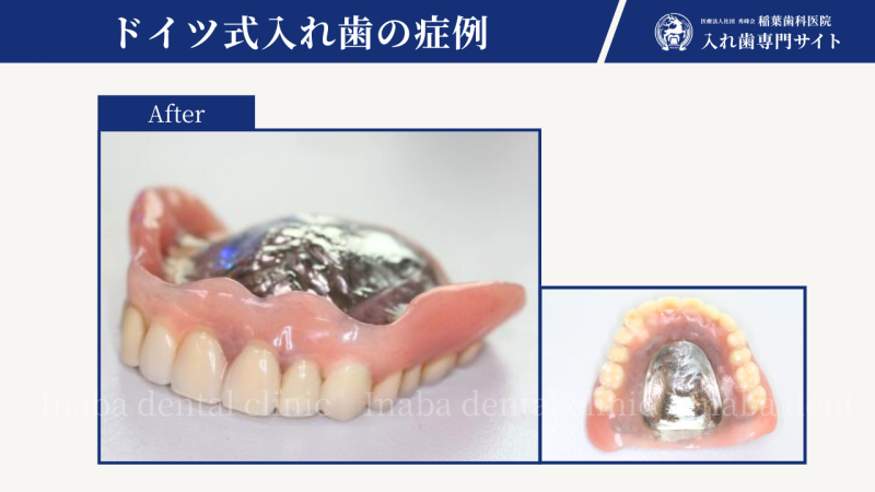 若い方の入れ歯のニーズ〜私のターニングポイントとなった症例〜