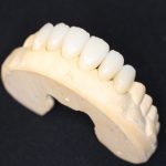 ジルコニアセラミックで、美しい前歯を手にいれることができた患者様（30代女性）
