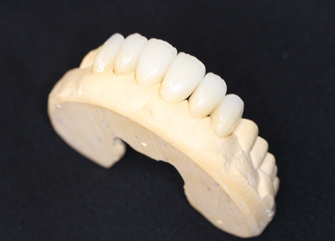 ジルコニアセラミックで、美しい前歯を手にいれることができた患者様(30代女性)