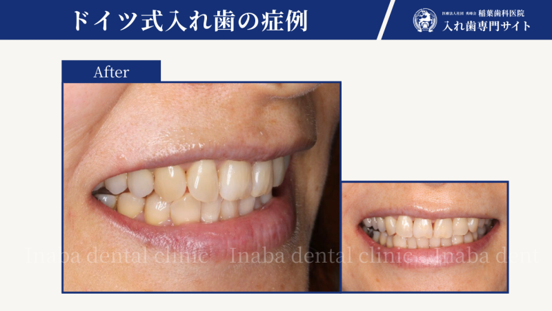 稲葉歯科医院の審美歯科治療について〜ジルコニアセラミック〜