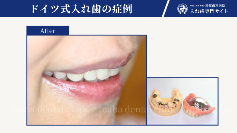 ルイヴィトンの工房のように作られた入れ歯