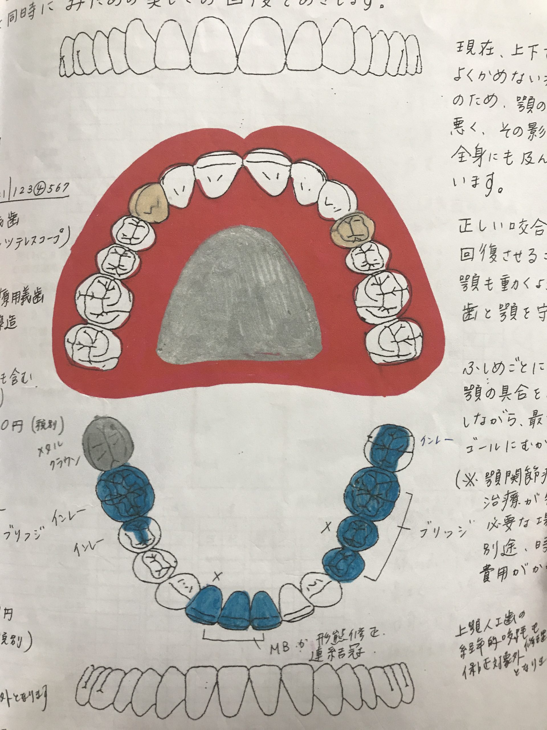 伊庭由夏先生の入れ歯治療の取り組み