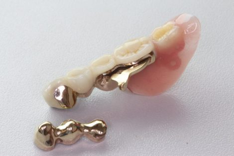 奥歯 2 入れ歯 本 部分 奥歯２本欠損、部分入れ歯以外の治療法を薦められないのはなぜ？