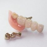 部分入れ歯　奥歯2本を失った場合の治療方法〜インプラントか入れ歯か〜