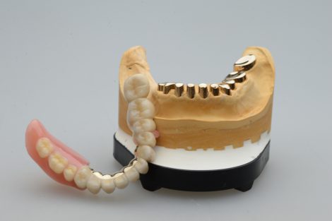 コーヌスクローネ義歯は安定している2