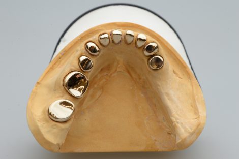 コーヌスクローネ義歯　内冠
