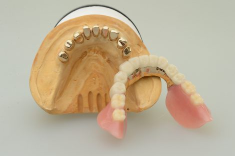 コーヌスクローネ義歯の完成
