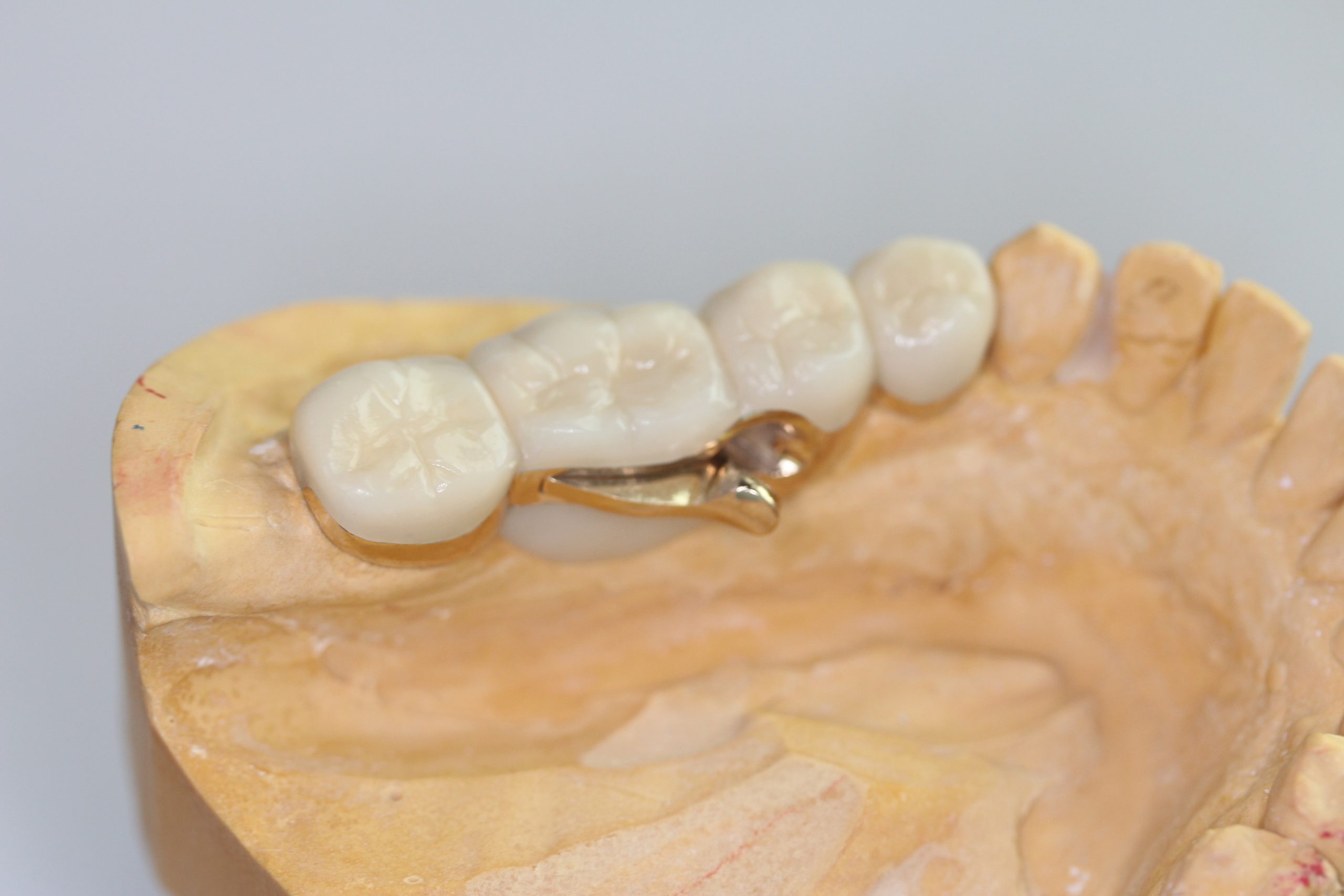 ブリッジかインプラントで悩まれている方へ~リーゲルテレスコープというもう一つの選択肢~