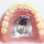 入れ歯の上あごの土台を削ることはできますか？