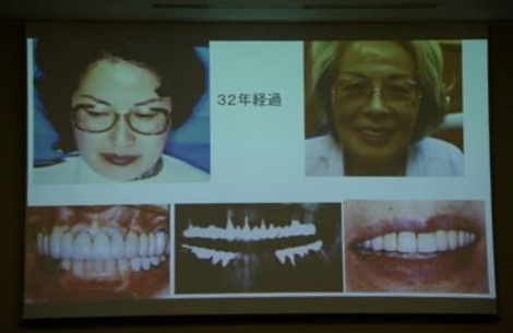 テレスコープ義歯は何年使えるのでしょうか。