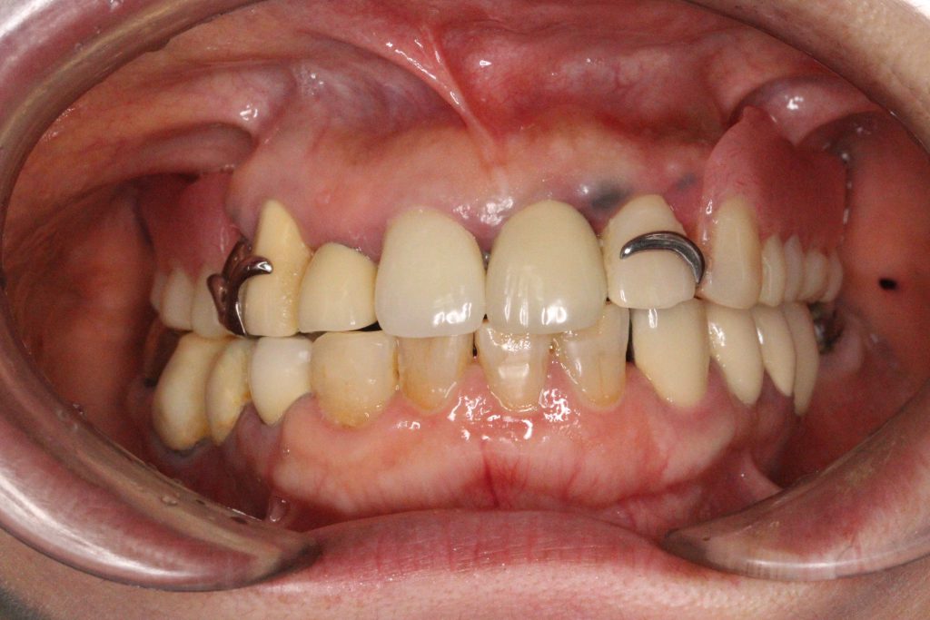 インプラント 以外 の 方法 前歯