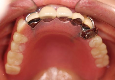奥歯 2 入れ歯 本 部分 部分入れ歯も悪くない！奥歯を抜歯したときのインプラント以外の方法