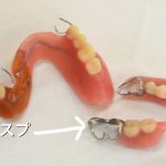 保険で対応できる、クラスプ義歯を使うとなぜ歯が抜けてしまうのでしょうか？