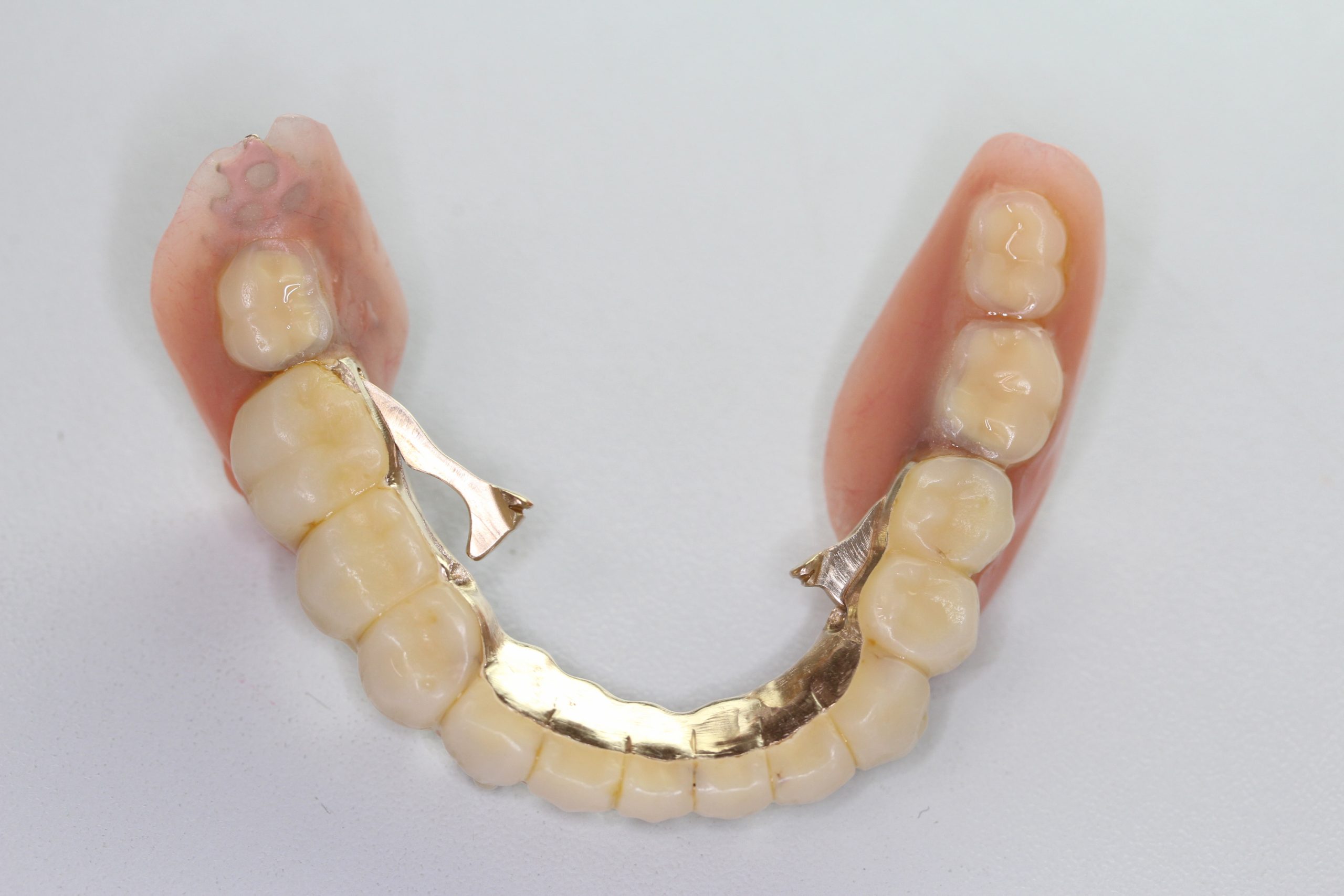 若い方にもおすすめしたい、テレスコープ義歯