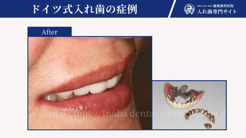 インプラントができないと言われたのですが、それに変わる方法は?(海外在住40代女性)