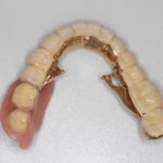 入れ歯の修理は、患者さまが困らないように即日にお返しさせていただいております〜テレスコープ義歯〜