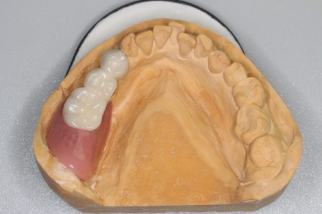 虫歯の奥歯を抜いたら どうなるの 東京千代田区のドイツ式入れ歯専門 稲葉歯科医院