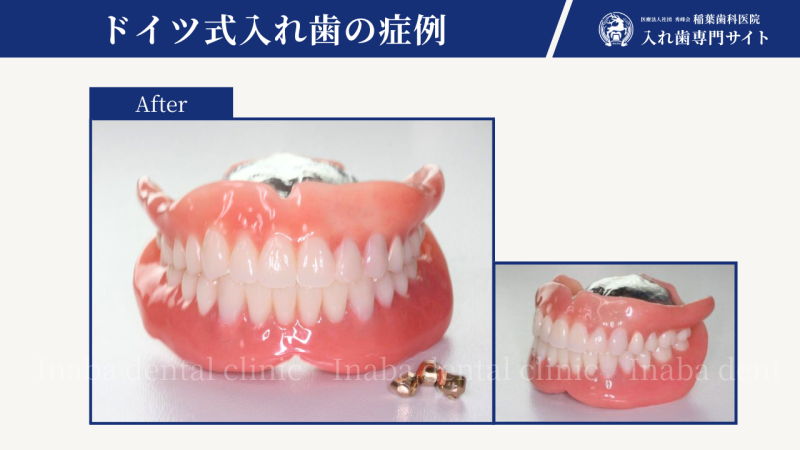 ブリッジからレジリエンツテレスコープで治療し、10年が経過しました。