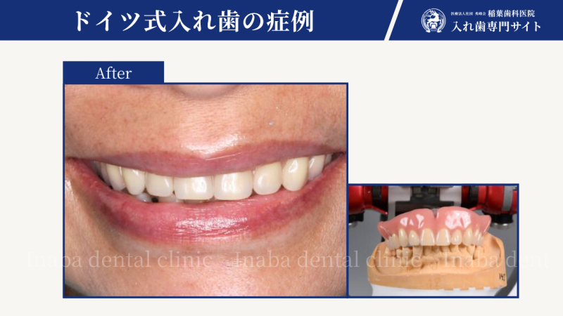 総入れ歯にするタイミングについて〜残せる歯があるかどうか不安です。(50代女性)〜