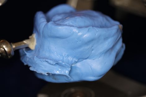 上下顎同時印象法による総入れ歯