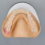 歯周病により下の前歯が抜けてしまった場合の治療方法について