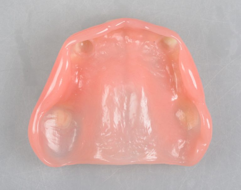 抜歯 から 部分 入れ歯 まで の 期間