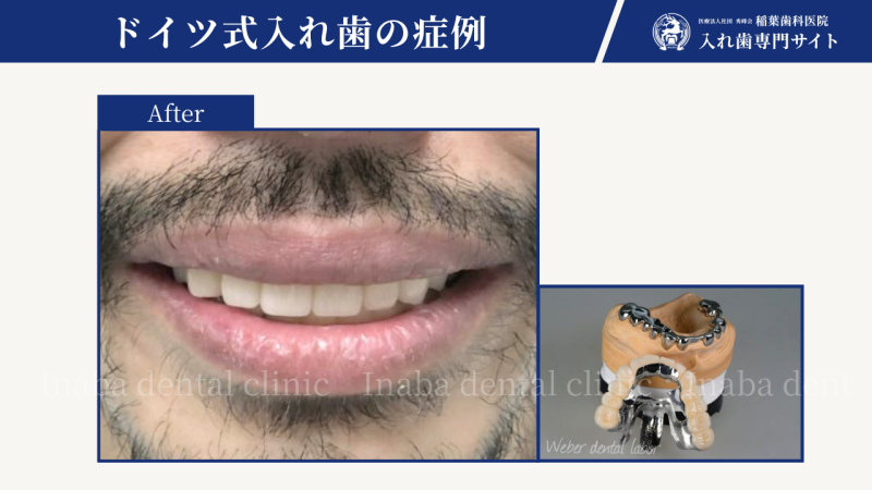 笑った時に上の歯が見えない~ドイツ式入れ歯で治した症例~