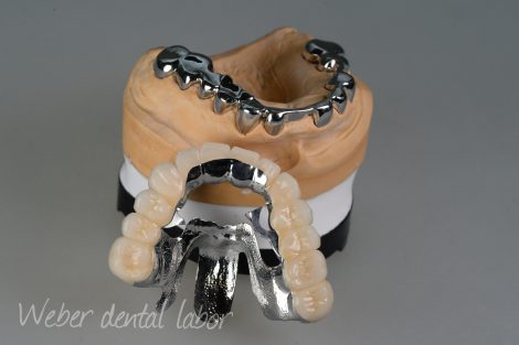 ドイツ式入れ歯リーゲルテレスコープ義歯