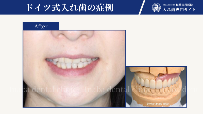 前歯のブリッジ、何本まで可能でしょうか?