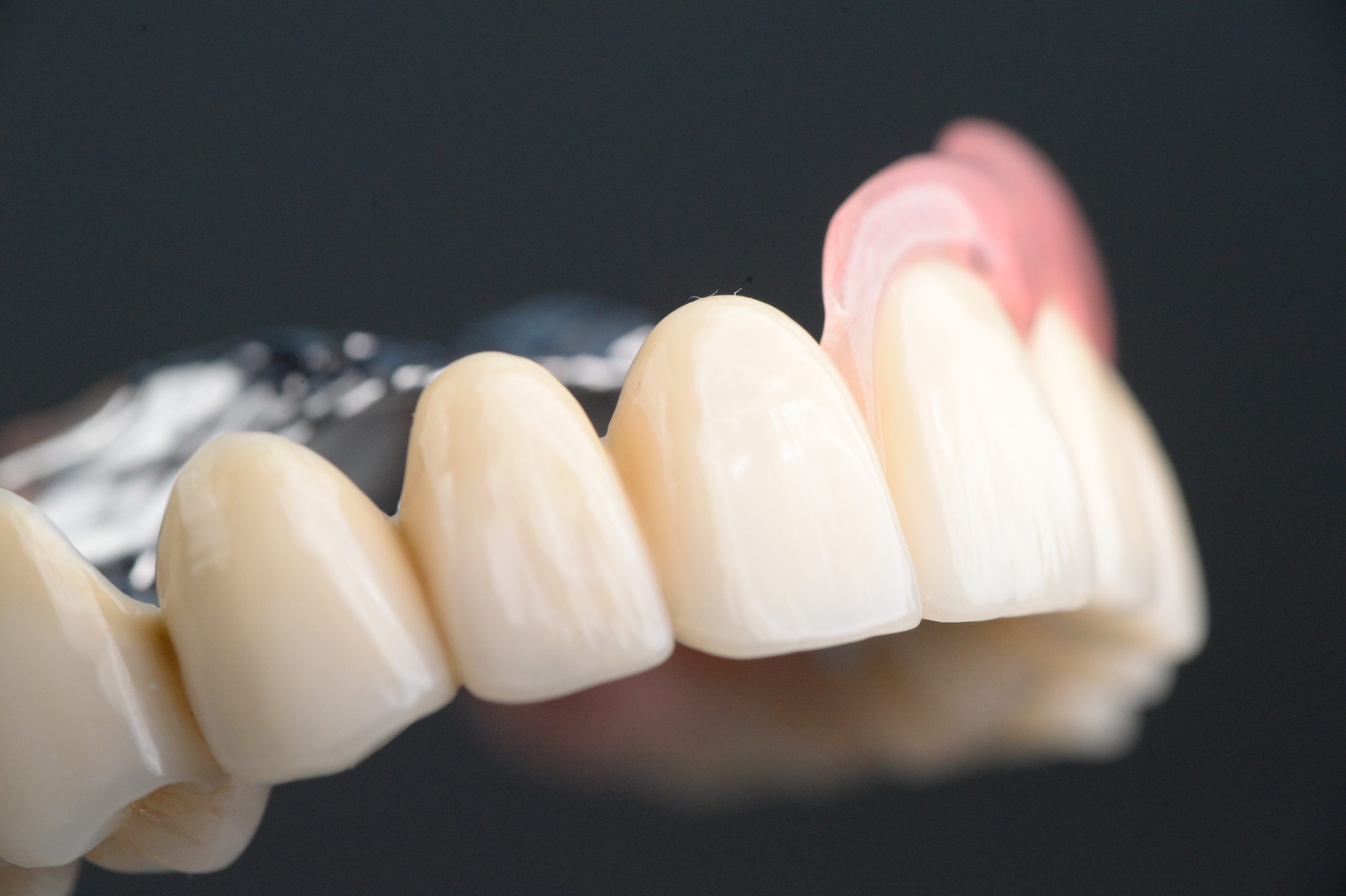 50代、前歯がほとんどない場合の治療方法を4つご紹介