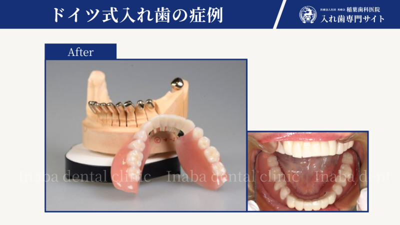 顎骨骨髄炎の患者さまの入れ歯治療