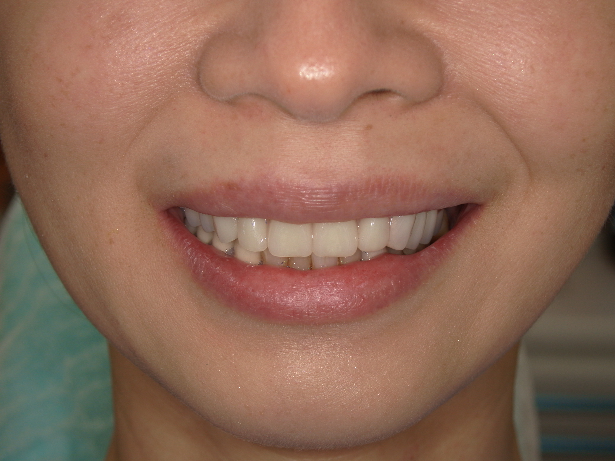 インプラントで満足できなかった方へ