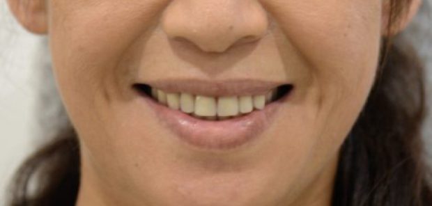 口元を自由に作ることができる総入れ歯