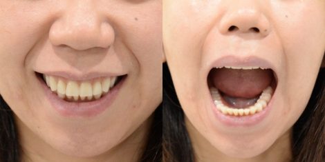 30代、インプラントと総入れ歯どちらがよいでしょうか?