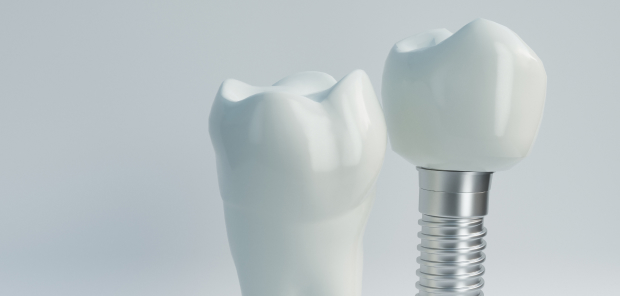 入れ歯とインプラントの違い