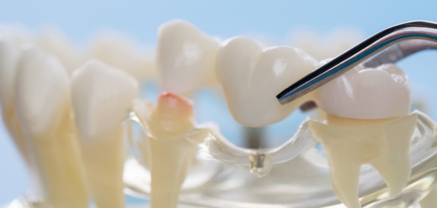 ブリッジで治療ができないと言われた方へ