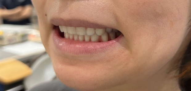 目立たない部分入れ歯