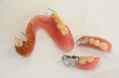 ブリッジが外れてしまうのが怖く、何年も前歯を使えない状態です。(40代女性)