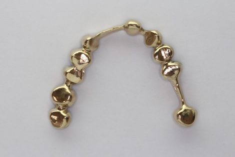 差し歯の土台にヒビが入ってるため、インプラントか入れ歯を検討中