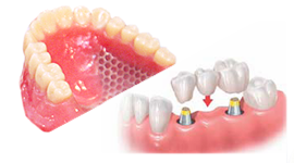 入れ歯とインプラントの違い