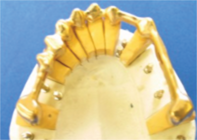 リーゲルテレスコープ内冠