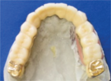 リーゲルテレスコープ外冠
(鍵を閉じたところ)