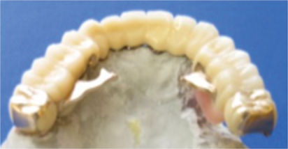 リーゲルテレスコープ外冠
(鍵を開いたところ)