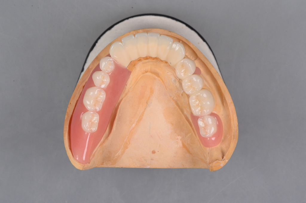 奥歯が続けて4本ない場合の治療方法を3つご紹介