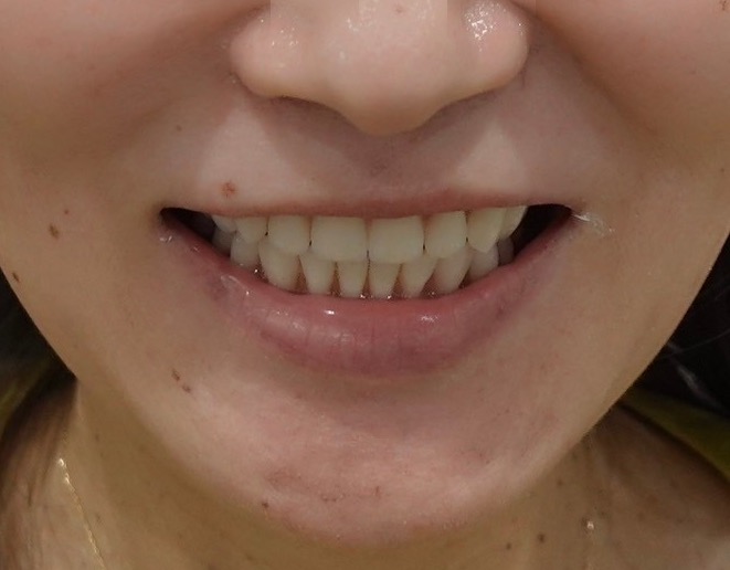 入れ歯=恥ずかしい時代は終わりました