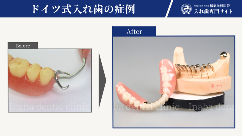 50代、両側奥歯がない〜ドイツ式入れ歯コーヌスクローネ〜