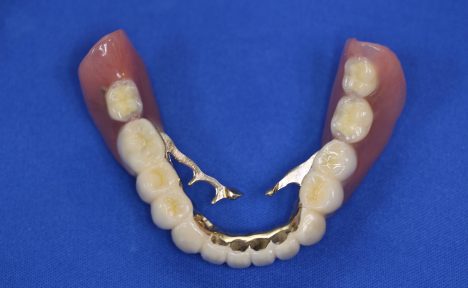 両側奥歯がない場合の治療方法4つ