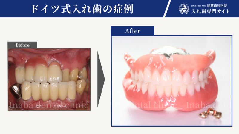 60代女性、将来は総入れ歯になりますよ〜ショッキングな宣告〜